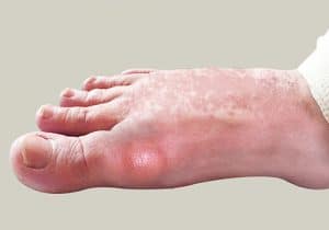 Gout - Toe joint pain