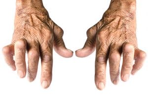 Rheumatoid arthritis - an autoimmune systemic inflammatory disease